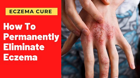 how to cure eczema easily naturally and forever