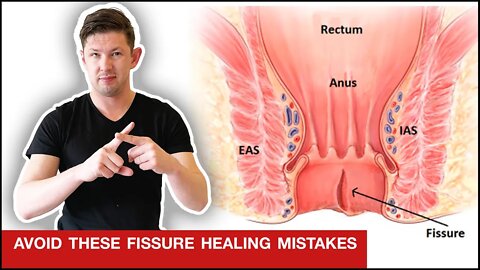 How to Heal Anal Fissures INSTANTLY