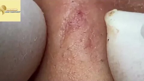 Giant blackheads on the lips!! blackheads and pimples removal/extraction!! satisfactory