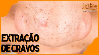 Só Relaxe Remoção de Cravos - Remove Cravos do Nariz Asmr - Just Relax | Apenas Relaxe