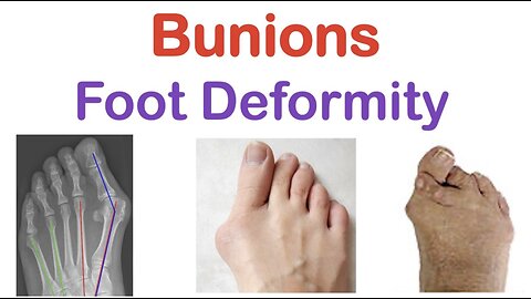 Bunions (Foot Deformity) | Types (& Bunionettes), Risk Factors, Symptoms, Diagnosis, Treatment