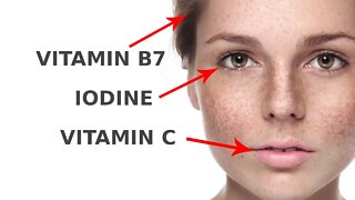 5 Vitamin Deficiencies That Show Up in Your Face