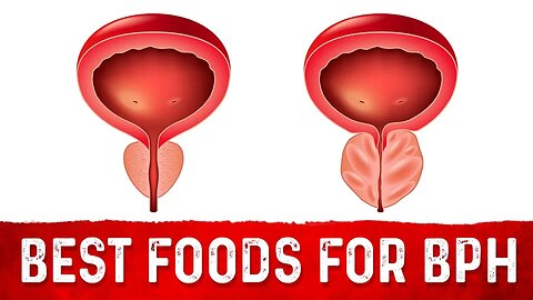 Best Foods For Benign Prostatic Hyperplasia (BPH) – Dr.Berg