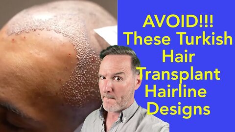 How To Spot Bad Hairlines From Turkey Hair Transplant Clinics