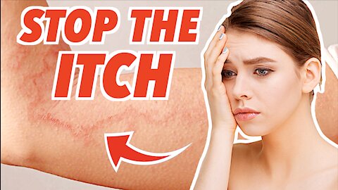NATURAL ECZEMA TREATMENTS - Home Remedies for ATOPIC DERMATITIS