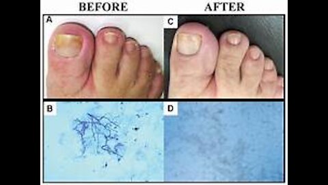 toenail fungus cures