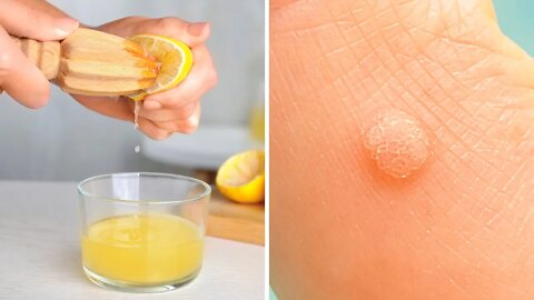 COMO REMOVER VERRUGAS EM CASA USANDO SUCO DE LIMÃO