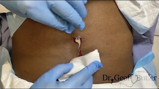 Drainage of an infected cyst on the back