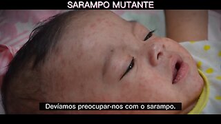 💉⚠️ANDREW WAKEFIELD-DEVEMOS PREOCUPAR-NOS COM O SARAMPO. NÃO É A MESMA DOENÇA QUE ERA ANTES DA VACINAÇÃO💉⚠️