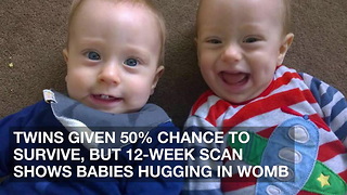 Twins Given 50% Chance to Survive, But 12-Week Scan Shows Babies Hugging in Womb