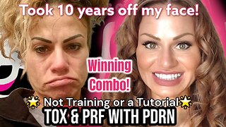 MY NATURAL Growth Factors (PRF) & PDRN ( Nova Eyes) / Softening Harsh Lines w/ Rentox