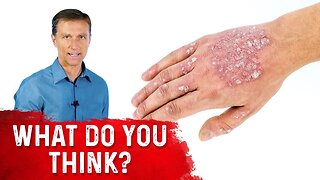 What is Psoriasis and Is Psoriasis Contagious? Explained by Dr.Berg