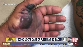 Ohio man contracts flesh-eating bacteria in Tampa Bay