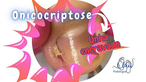 ONICOCRIPTOSE = UNHA ENCRAVADA retirada rápida e EFICIENTE #unhas #pes #dor #podologia #profissional