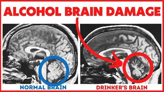 11 Ways Alcohol Induces Brain Damage - Often Irreversible!