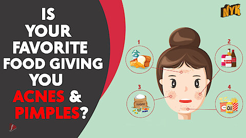 4 Surprising foods that might be giving you acne &amp