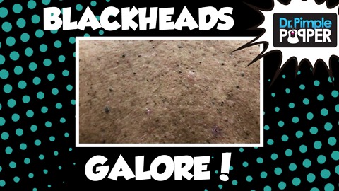Blackheads Galore
