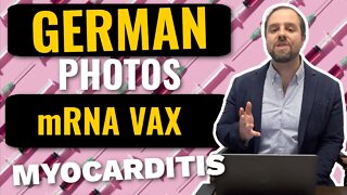 German Photographs - Myocarditis After Vaccination | Adding To Dr. John Campbell's Analysis