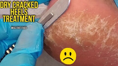 Get Rid of Your Dry Cracked Heels - How to Treat Cracked Heels Full Treatment by miss foot fixer