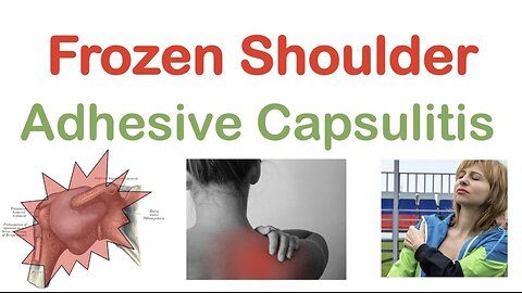 Frozen Shoulder (Adhesive Capsulitis): Causes, Symptoms, Stages, Diagnosis, Treatment