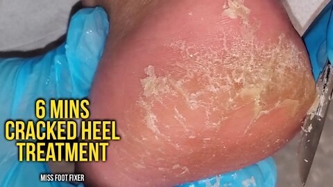 Remove Cracked Heels - So satisfying, 6 mins Cracked heel treatment by foot doctor miss foot fixer