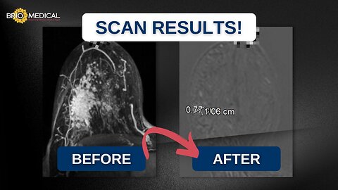 From Stage 4 Breast Cancer to 4 Clear PET Scans! | Brio-Medical Cancer Clinic