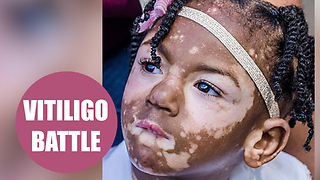 Girl developed vitiligo all over her body - triggered by a battle with meningitis