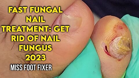 Fast & Reliable Fungal Nail Treatment: Get Rid of Nail Fungus by famous foot doctor miss foot fixer