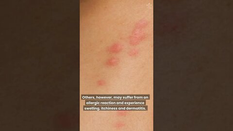 What Bit Me? How To Identify The Most Common Bug Bites #shorts