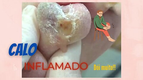 Calo INFLAMADO, dói muito!!! #unhas #pes #dor #podologia #calos #inflamação #procedimento