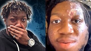 OG Maco Explains His Flesh Eating Disease Situation