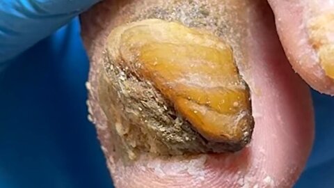 Amazing toenails, too thick, trim them slowly