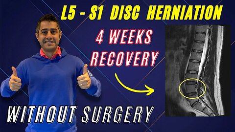 L4 L5 L5 S1 disc herniation recovery within 4 weeks