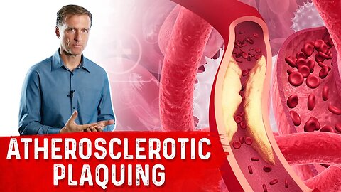 Protocol for Calcified Plaque in Your Arteries – Atherosclerosis – Dr.Berg
