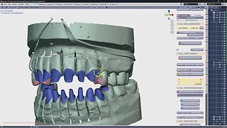 Opposing crowns?