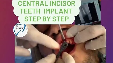 Central incisor teeth implant #video #viral #Dental implants