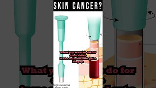 Skin Cancer [Don't Ignore The Warning Signs!]
