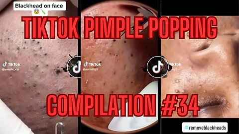 Soooo Many Blackheads On Their Face! - TikTok Pimple Popping Compilation - EP#34