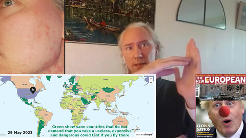 (Swedish... Wrongly posted here. See my last video for the English video)Surprisingly covid1984 free countries. Ukraine & Bojo the clown collapsing. Insanities. Skin problem