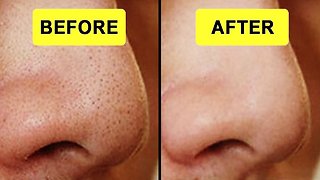 How To Remove Blackheads Naturally