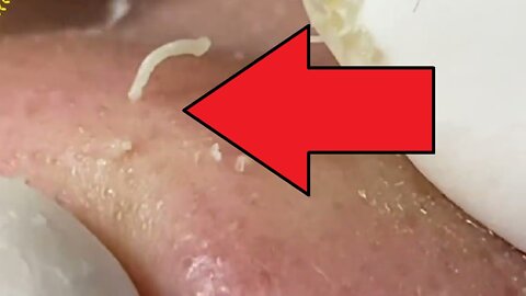 Squeezing giant blackheads and pimples