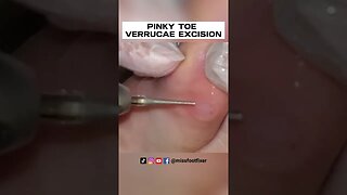 PINKY TOE VERRUCAE EXCISION