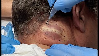 Drainage of a mildly inflamed cyst on the neck