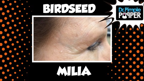 Birdseed Milia