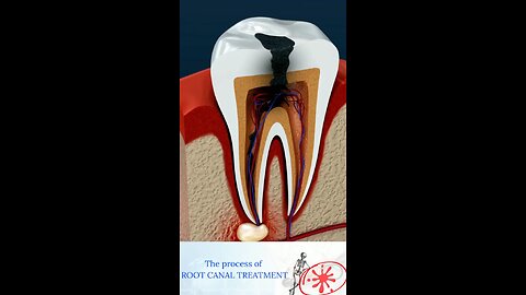 Root_Canal_Treatment_&_Tooth_Abscess