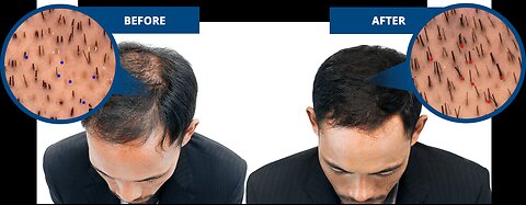 Baldness - Exploring Nutritional and Medical Hair Loss Interventions