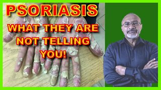 Psoriasis (More Than Just A Rash!)