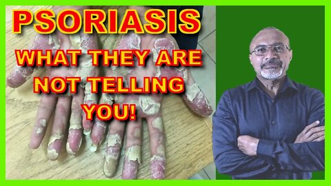 Psoriasis (More Than Just A Rash!)