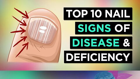 10 NAIL SIGNS of HEALTH PROBLEMS (and Nutritional Deficiencies)