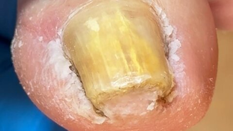 Amazing ingrown toenail, big and deep, be careful to remove it